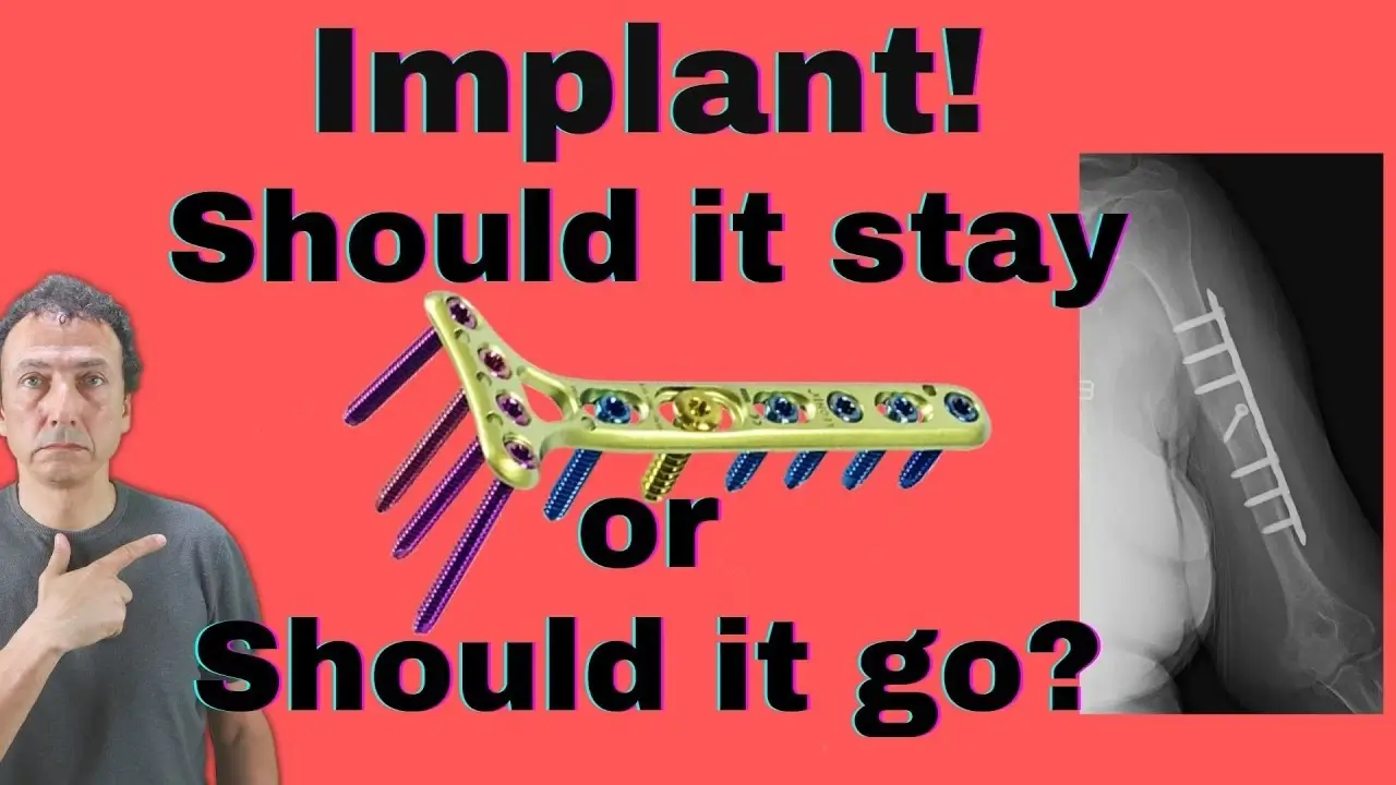 Should the implants be removed after the fracture healed?