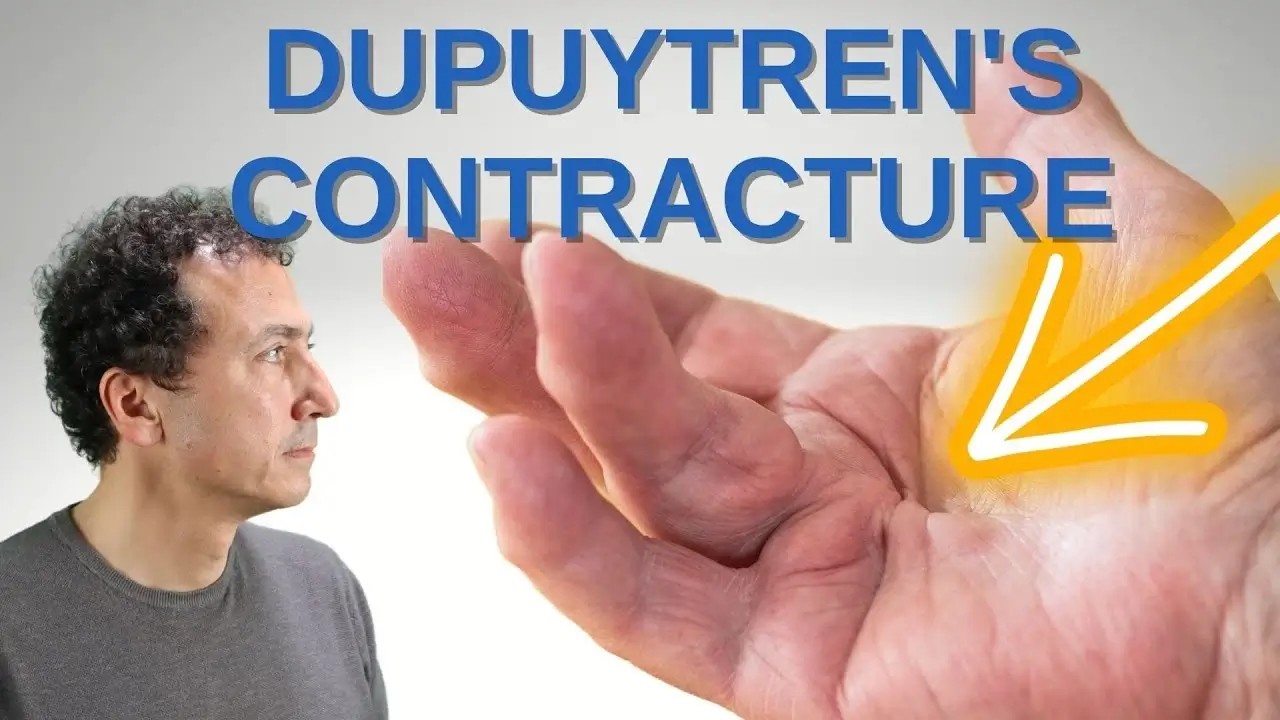 Dupuytren's contracture - How to treat it